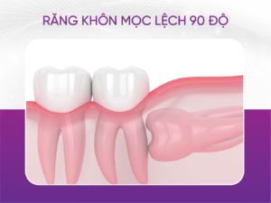 Răng Khôn Mọc Lệch 90