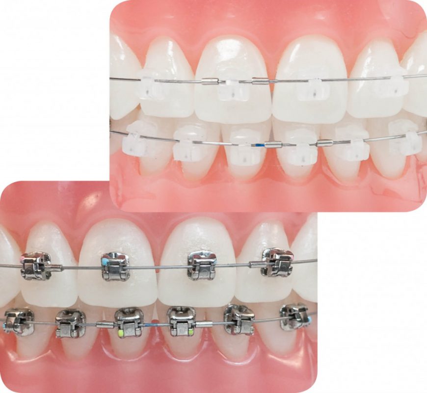 Tác dụng của niềng răng và 7 lợi ích không ngờ Tác Dụng Của Niềng Răng Và 7 Lợi Ích Không Ngờ