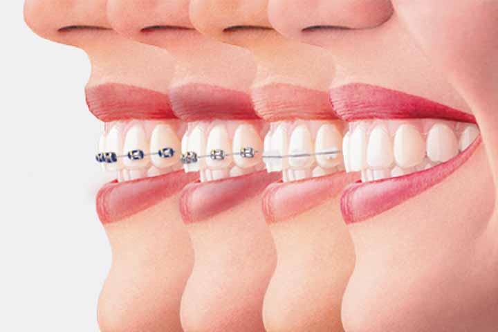 Tác dụng của niềng răng và 7 lợi ích không ngờ Tác Dụng Của Niềng Răng Và 7 Lợi Ích Không Ngờ