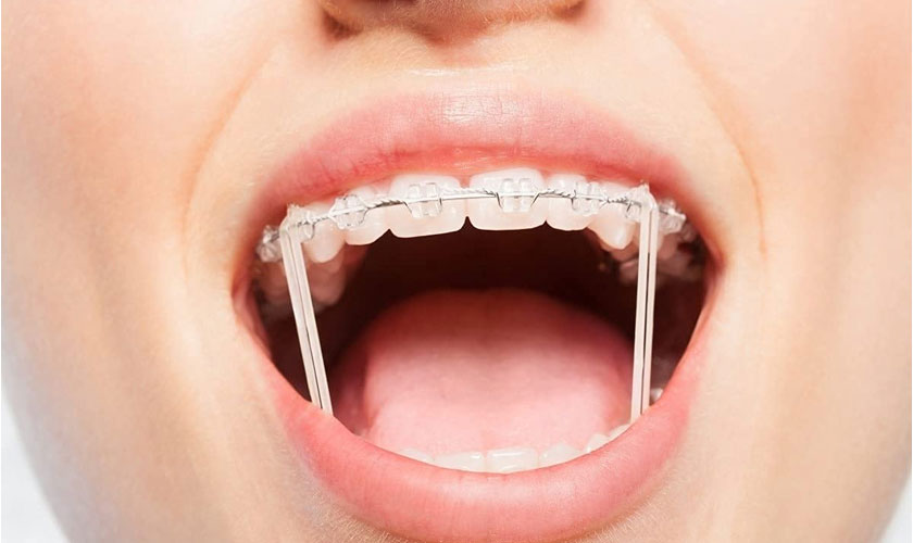 Tác dụng của niềng răng và 7 lợi ích không ngờ Tác Dụng Của Niềng Răng Và 7 Lợi Ích Không Ngờ