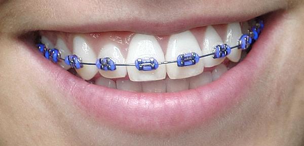 Tác dụng của niềng răng và 7 lợi ích không ngờ Tác Dụng Của Niềng Răng Và 7 Lợi Ích Không Ngờ