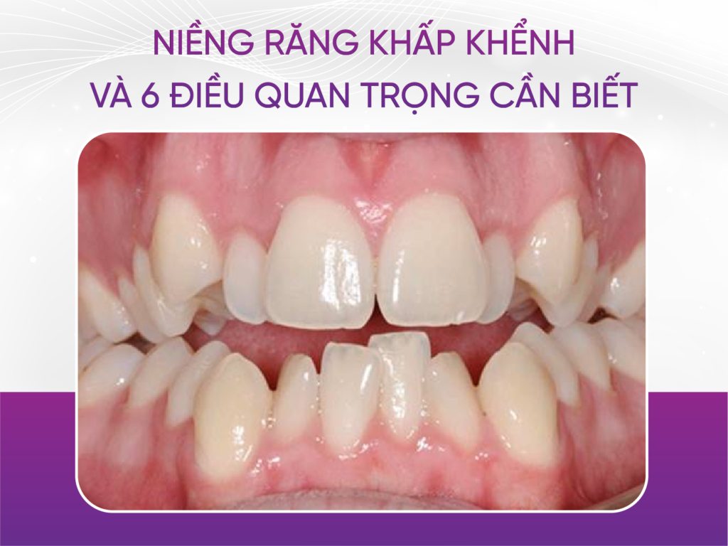 Niềng Răng Khấp Khểnh Và 6 Điều Quan Trọng Cần Biết