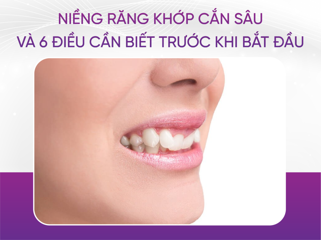Niềng Răng Khớp Cắn Sâu Và 6 Điều Cần Biết Trước Khi Bắt Đầu