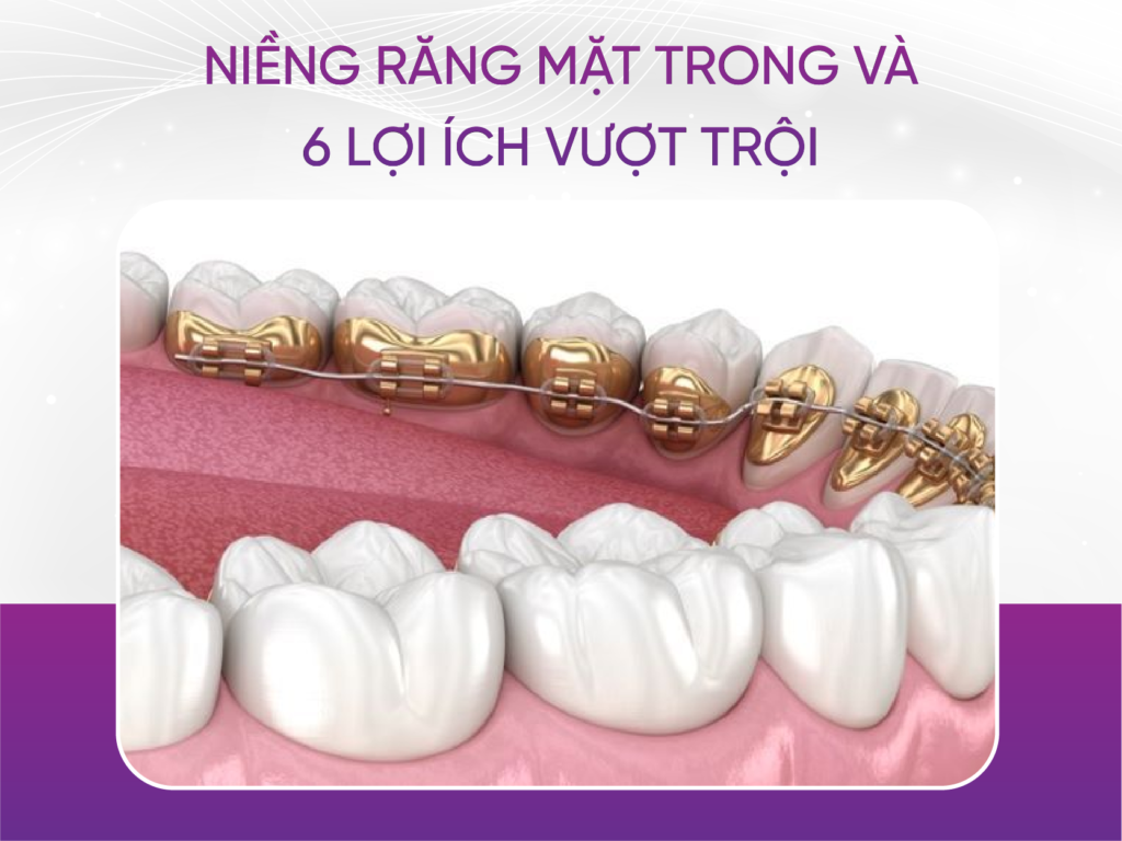 Niềng răng mặt trong và 6 lợi ích vượt trội Niềng Răng Mặt Trong Và 6 Lợi Ích Vượt Trội