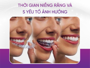 Thời Gian Niềng Răng Và 5 Yếu Tố Ảnh Hưởng