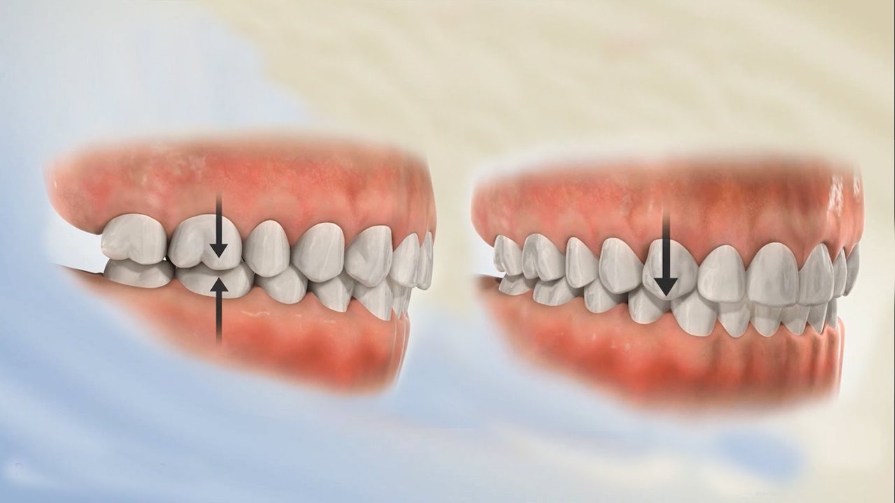 Niềng răng 1 hàm và 5 điều cần biết trước khi điều trị Niềng Răng 1 Hàm Và 5 Điều Cần Biết Trước Khi Điều Trị