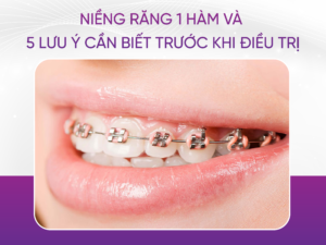 Niềng Răng 1 Hàm Và 5 Lưu Ý Cần Biết