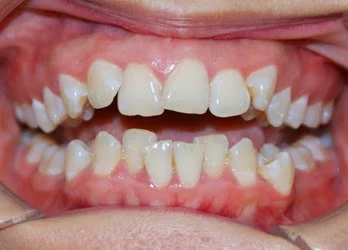 Niềng răng khấp khểnh và 6 điều quan trọng cần biết Niềng Răng Khấp Khểnh Và 6 Điều Quan Trọng Cần Biết