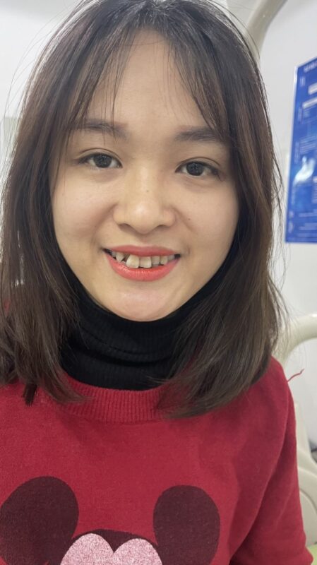 Niềng răng khấp khểnh và 6 điều quan trọng cần biết Niềng Răng Khấp Khểnh Và 6 Điều Quan Trọng Cần Biết