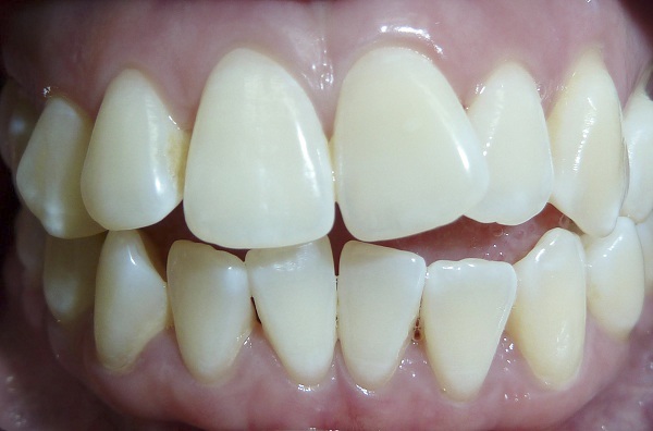 Niềng răng khấp khểnh và 6 điều quan trọng cần biết Niềng Răng Khấp Khểnh Và 6 Điều Quan Trọng Cần Biết