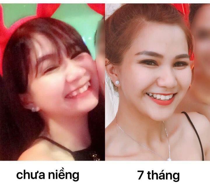 Niềng răng khấp khểnh và 6 điều quan trọng cần biết Niềng Răng Khấp Khểnh Và 6 Điều Quan Trọng Cần Biết
