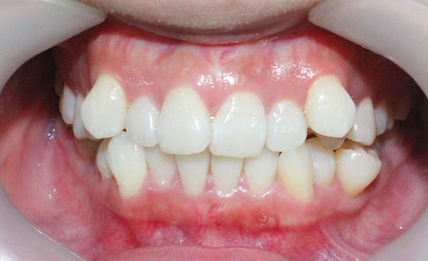 Niềng răng khấp khểnh và 6 điều quan trọng cần biết Niềng Răng Khấp Khểnh Và 6 Điều Quan Trọng Cần Biết