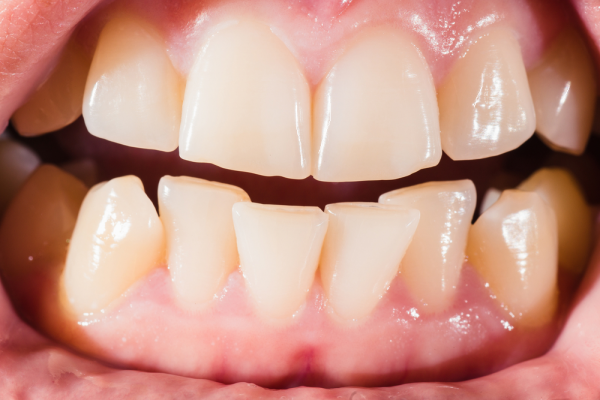 Niềng răng khấp khểnh và 6 điều quan trọng cần biết Niềng Răng Khấp Khểnh Và 6 Điều Quan Trọng Cần Biết