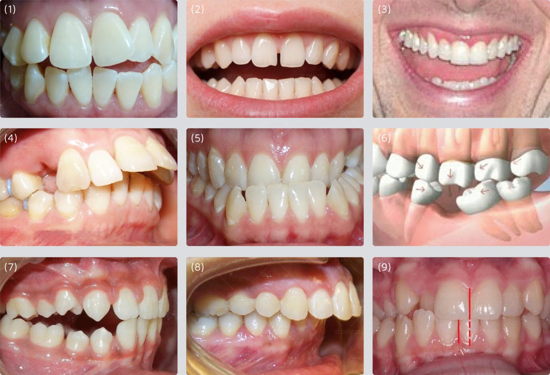 Niềng răng khấp khểnh và 6 điều quan trọng cần biết Niềng Răng Khấp Khểnh Và 6 Điều Quan Trọng Cần Biết
