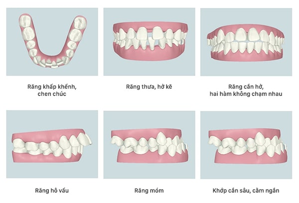 Niềng răng khấp khểnh và 6 điều quan trọng cần biết Niềng Răng Khấp Khểnh Và 6 Điều Quan Trọng Cần Biết