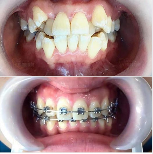 Niềng răng khấp khểnh và 6 điều quan trọng cần biết Niềng Răng Khấp Khểnh Và 6 Điều Quan Trọng Cần Biết