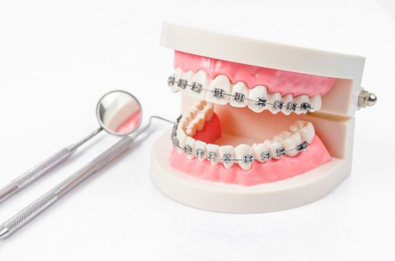 Niềng răng khớp cắn sâu và 6 điều cần biết trước khi bắt đầu Niềng Răng Khớp Cắn Sâu Và 6 Điều Cần Biết Trước Khi Bắt Đầu