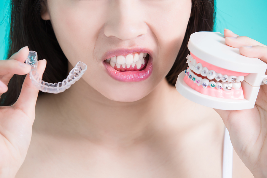 Niềng răng khớp cắn sâu và 6 điều cần biết trước khi bắt đầu Niềng Răng Khớp Cắn Sâu Và 6 Điều Cần Biết Trước Khi Bắt Đầu