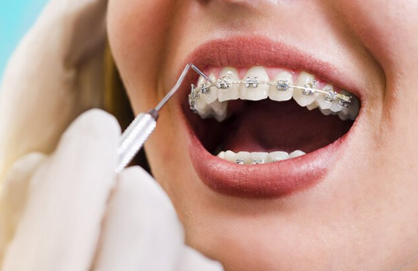 Thời gian niềng răng và 5 yếu tố ảnh hưởng Thời Gian Niềng Răng Và 5 Yếu Tố Ảnh Hưởng