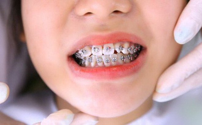 Thời gian niềng răng và 5 yếu tố ảnh hưởng Thời Gian Niềng Răng Và 5 Yếu Tố Ảnh Hưởng