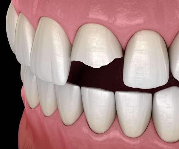 Trám răng cửa bao nhiêu tiền và quy trình 3 bước chuẩn y tế