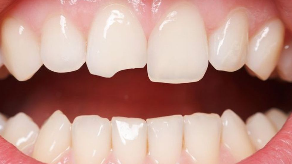 Trám răng cửa bao nhiêu tiền và quy trình 3 bước chuẩn y tế