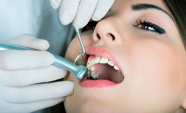Trám răng Những điều cần biết và các lời khuyên