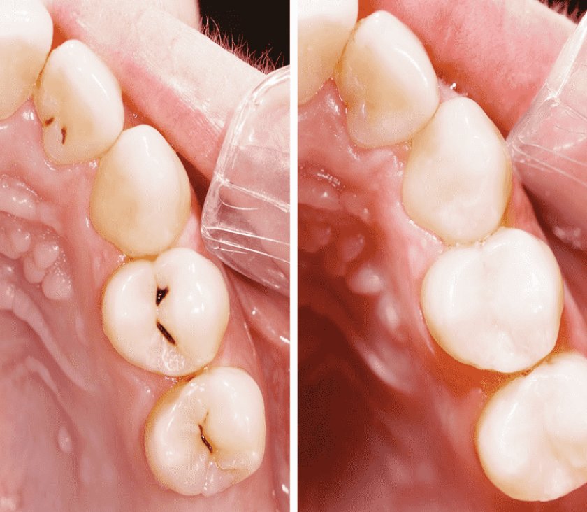 Trám răng Những điều cần biết và các lời khuyên
