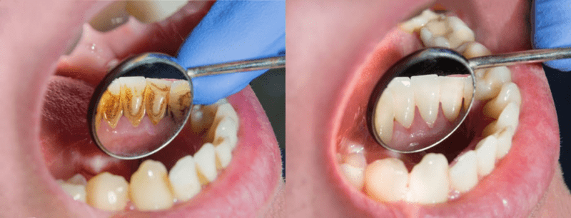 Trám răng sâu bao nhiêu tiền và 6 nguyên nhân sâu răng