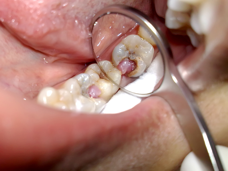 Trám răng sâu bao nhiêu tiền và 6 nguyên nhân sâu răng
