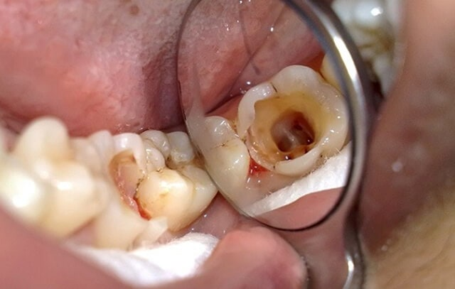 Trám răng sâu bao nhiêu tiền và 6 nguyên nhân sâu răng