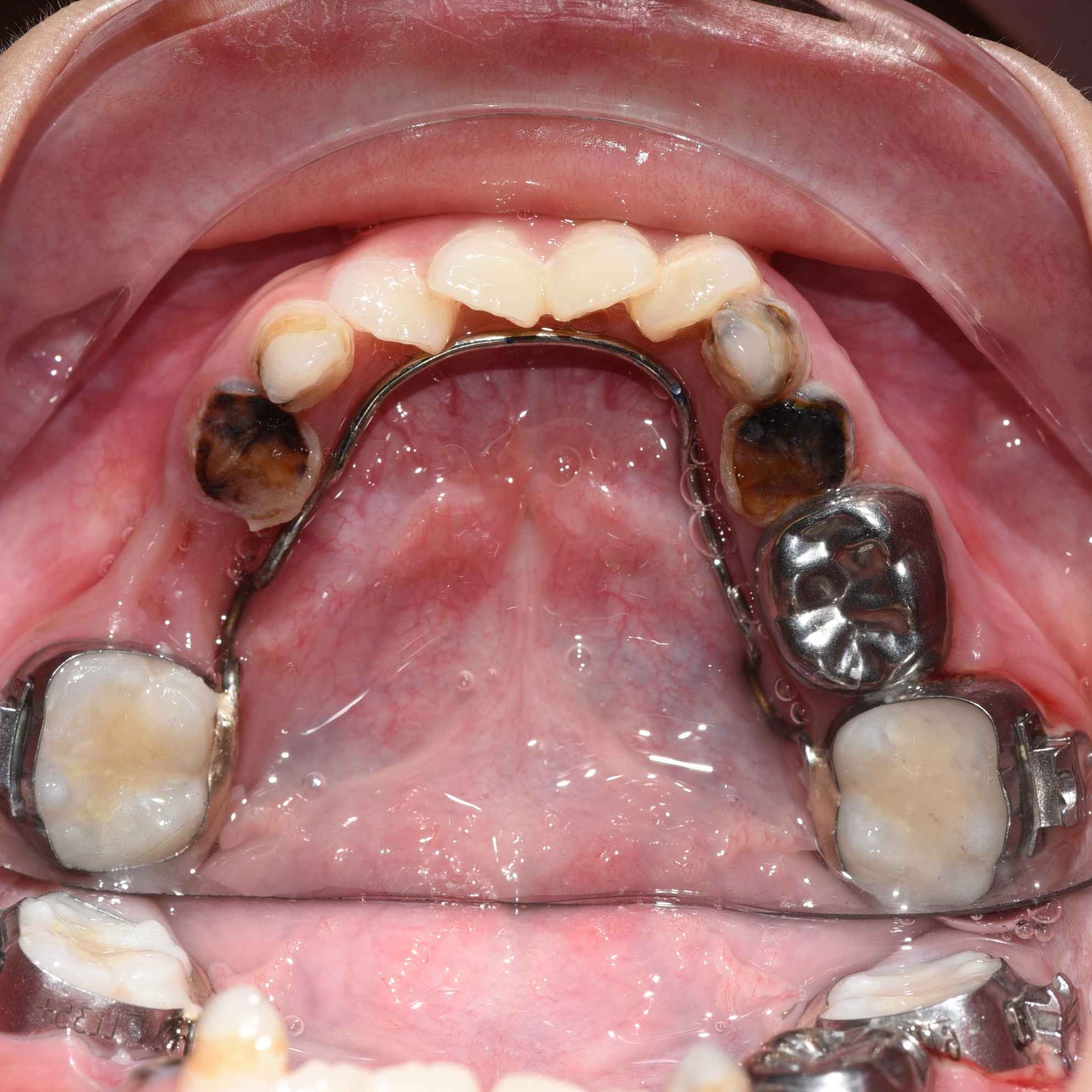 Trám răng sâu lỗ to bao nhiêu tiền Một khía cạnh quan trọng trong việc chăm sóc răng miệng của bạn