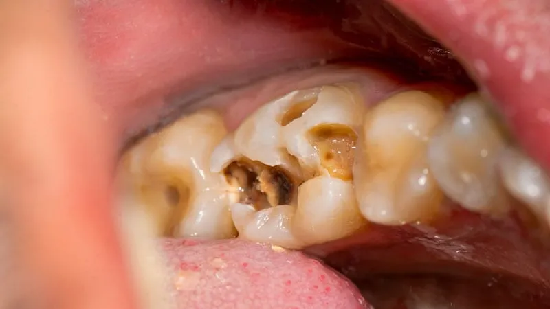Trám răng sâu lỗ to bao nhiêu tiền Một khía cạnh quan trọng trong việc chăm sóc răng miệng của bạn