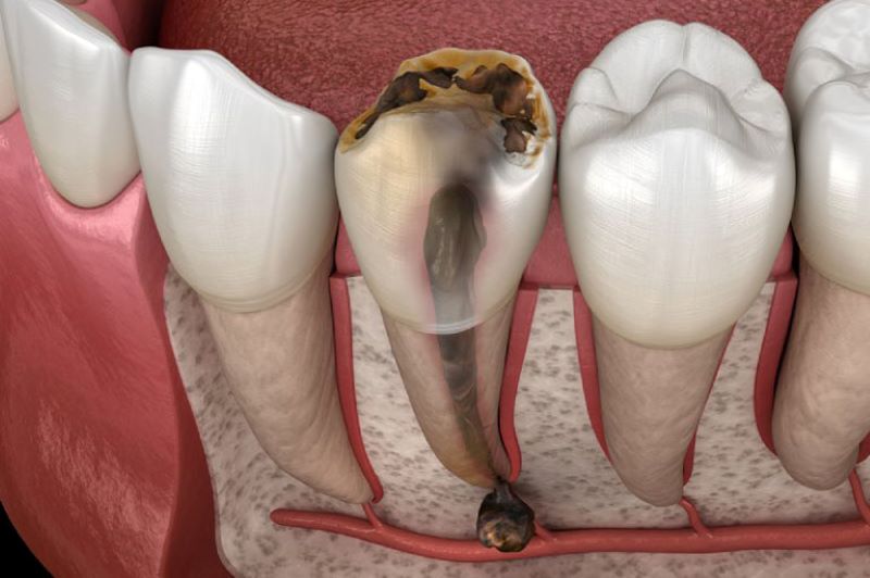Trám răng sâu lỗ to bao nhiêu tiền Một khía cạnh quan trọng trong việc chăm sóc răng miệng của bạn