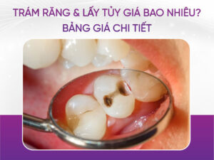 Trám Răng Và Lấy Tủy Giá Bao Nhiêu 2025