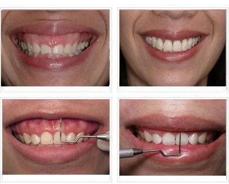 Chữa cười hở lợi: 5 phương pháp điều trị hiệu quả