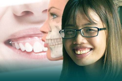 Chữa cười hở lợi: 5 phương pháp điều trị hiệu quả