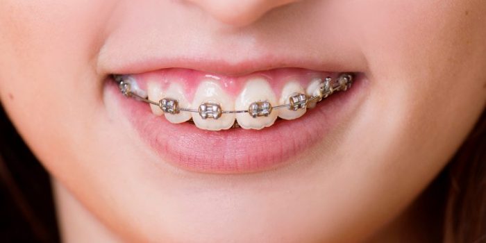 Chữa cười hở lợi: 5 phương pháp điều trị hiệu quả