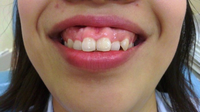 Chữa cười hở lợi: 5 phương pháp điều trị hiệu quả