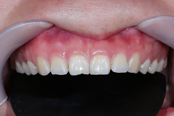 Chữa cười hở lợi: 5 phương pháp điều trị hiệu quả