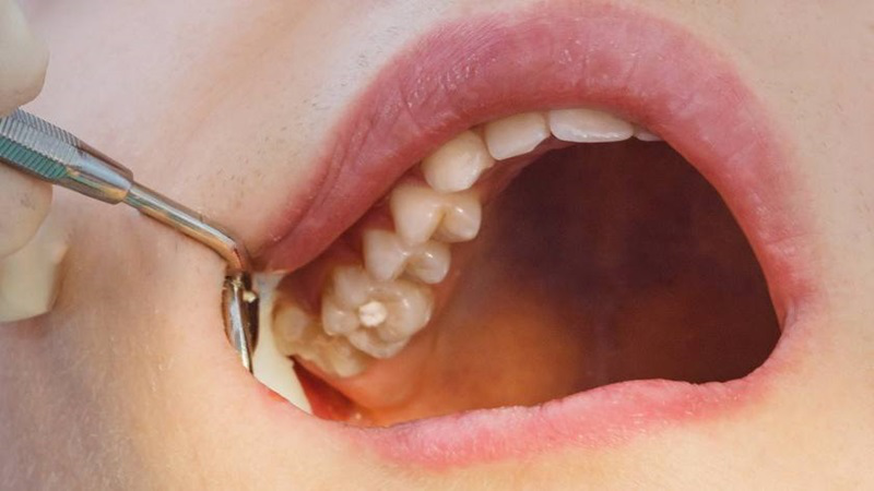 Có nên nhổ răng khôn?