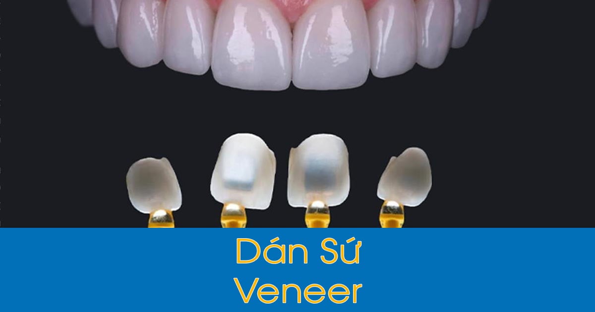 Dán sứ veneer: 5 điều cần biết trước khi thực hiện