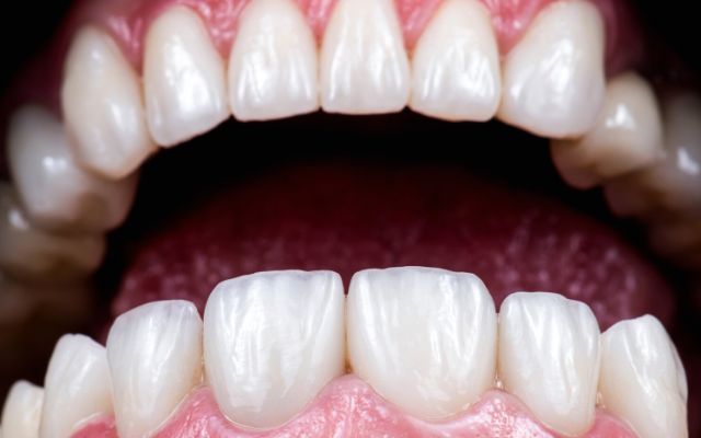 Dán sứ veneer: 5 điều cần biết trước khi thực hiện
