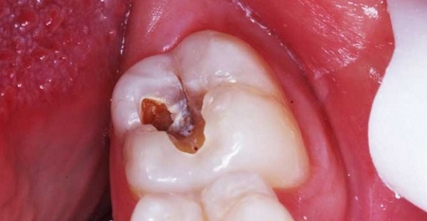 Điều trị tủy răng: Quy trình và chi phí mới nhất 2024