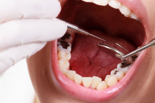 Điều trị tủy răng: Quy trình và chi phí mới nhất 2024