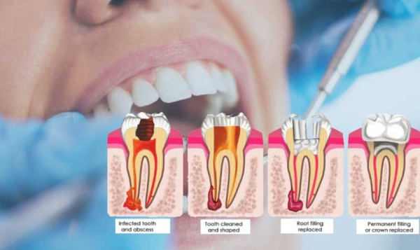 Điều trị tủy răng: Quy trình và chi phí mới nhất 2024