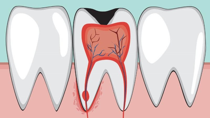 Điều trị tủy răng: Quy trình và chi phí mới nhất 2024
