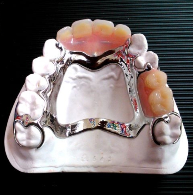 Hàm tháo lắp là gì và 5 ưu điểm nổi bật cần biết