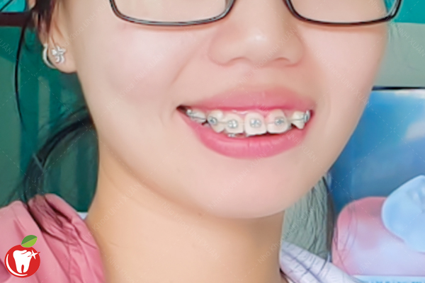 Răng hô là gì? 4 phương pháp điều trị hiệu quả