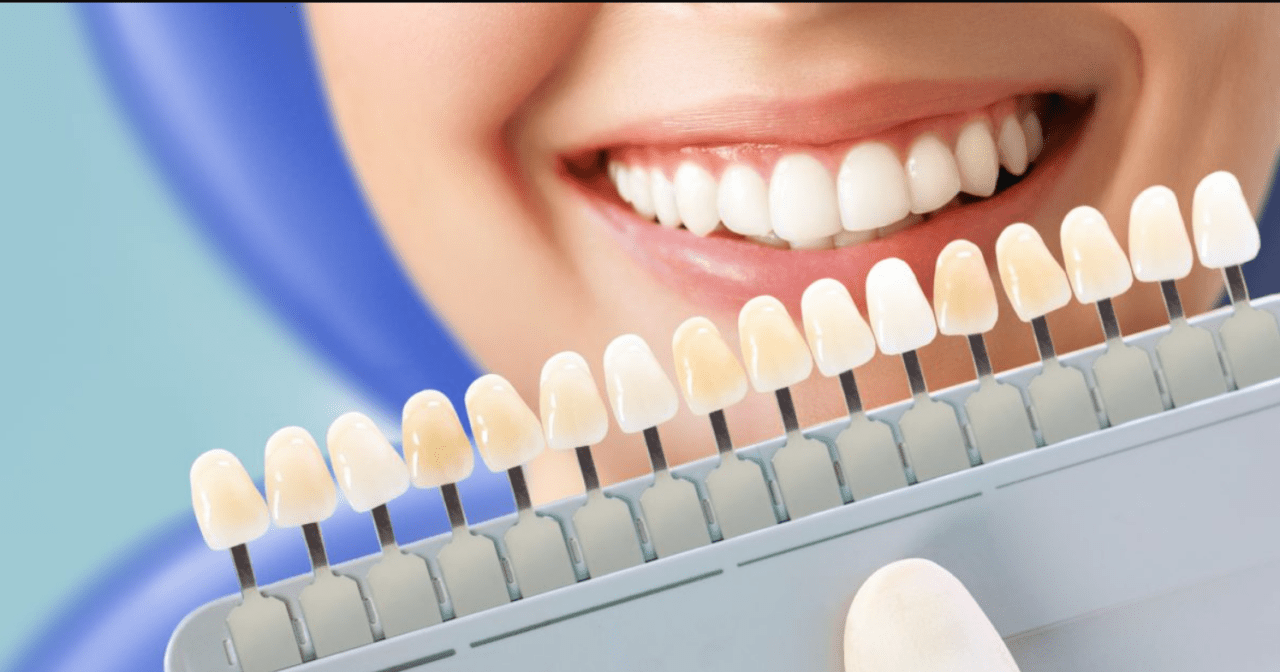 Tẩy trắng răng: Quy trình và chi phí mới nhất 2024